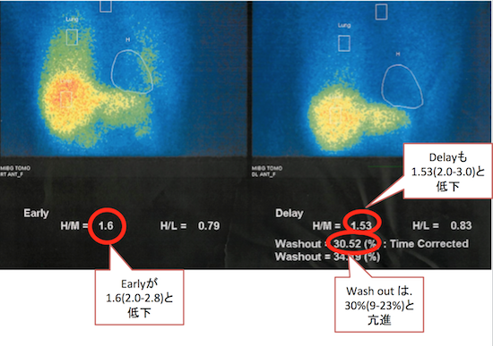 123I-MIBG心筋シンチの画像診断(H/M比の値、パーキンソン病、DLBの診断)
